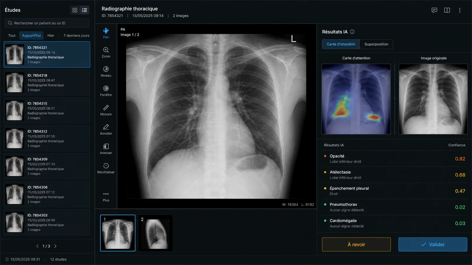 Aperçu de Modèle d'IA pour la Prédiction de Maladies à partir d'Images Radiologiques